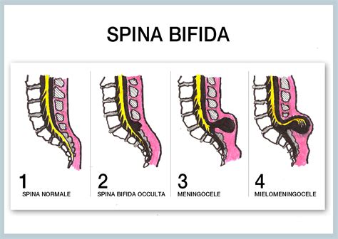 Spina.