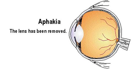 aphkhihe