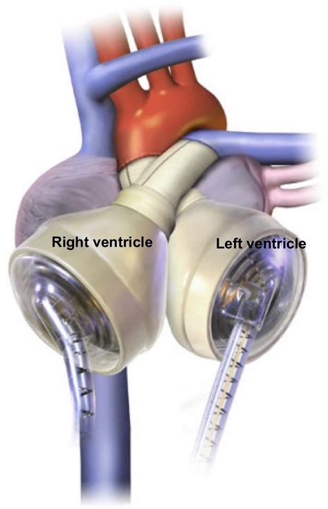 cardiowest