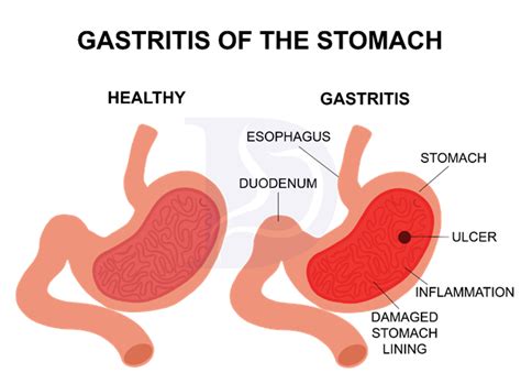 gastrid